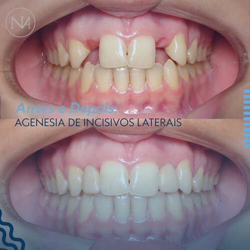 CLINICA-NASSER-AGENESIA-DE-INCISIVOS-LATERAIS