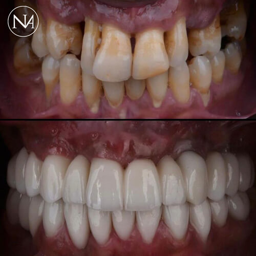 CLINICA-NASSER---COROA-DE-PORCELANA-03