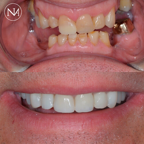 CLINICA-NASSER---COROA-DE-PORCELANA-04