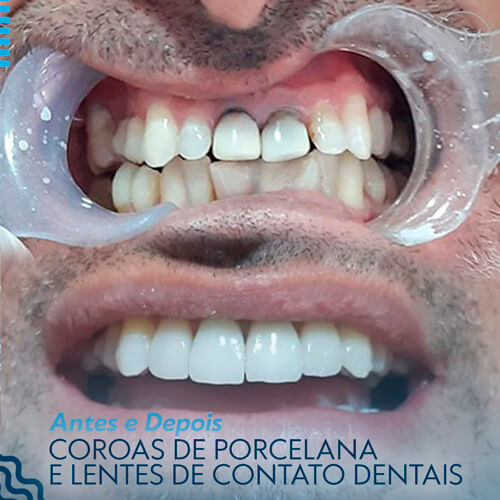 CLINICA-NASSER---COROA-DE-PORCELANA