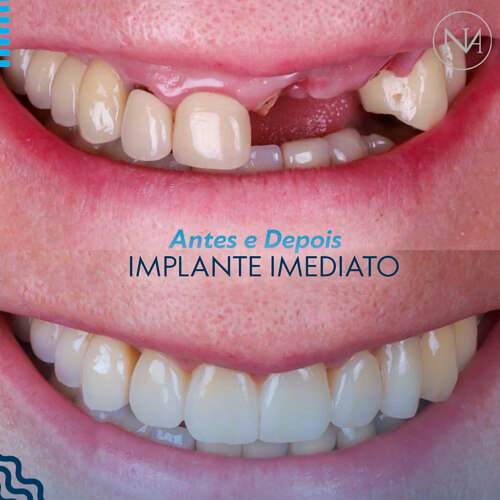 CLINICA-NASSER---IMPLANTE-IMEDIATO