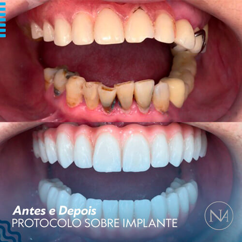 CLINICA-NASSER---PROTOCOLO-SOBRE-IMPLANTE-02