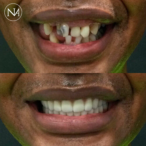 CLINICA-NASSER---PROTOCOLO-SOBRE-IMPLANTE-03