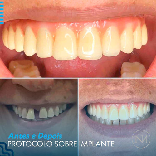 CLINICA-NASSER---PROTOCOLO-SOBRE-IMPLANTE
