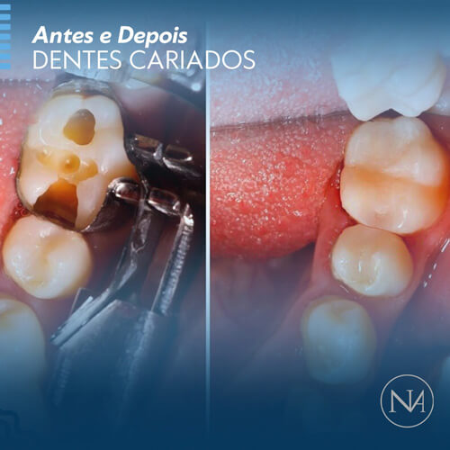 CLINICA-NASSER-REMOÇÃO-DE-CARIES-01