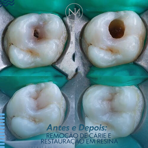 CLINICA-NASSER-REMOÇÃO-DE-CARIES