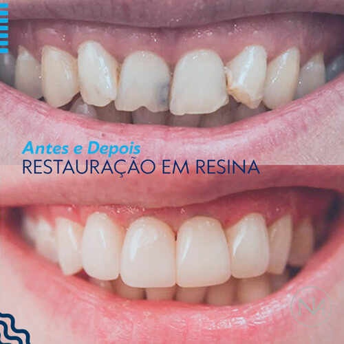 CLINICA-NASSER---RESTAURAÇÃO-EM-RESINA