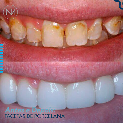 FACETAS-PORCELANA--NASSER-02