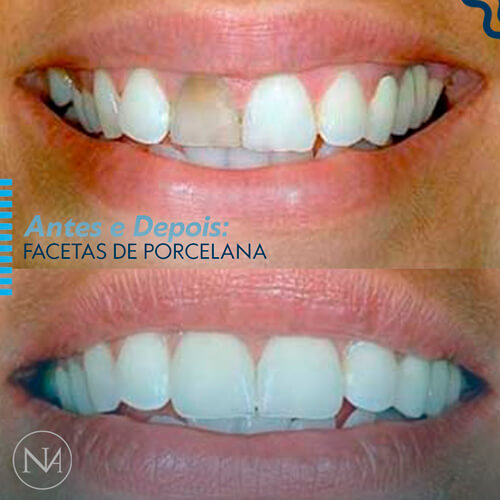 FACETAS-PORCELANA--NASSER-03