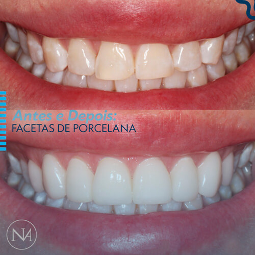 FACETAS-PORCELANA--NASSER-04