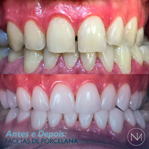 FACETAS-PORCELANA--NASSER-07