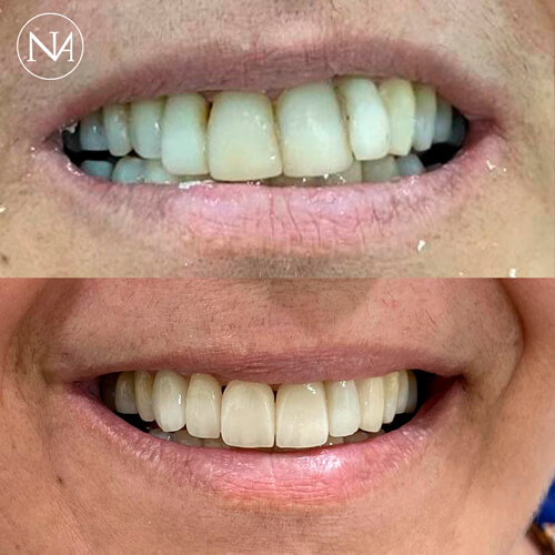 FACETAS-PORCELANA--NASSER-09-1