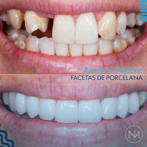FACETAS-PORCELANA--NASSER-09