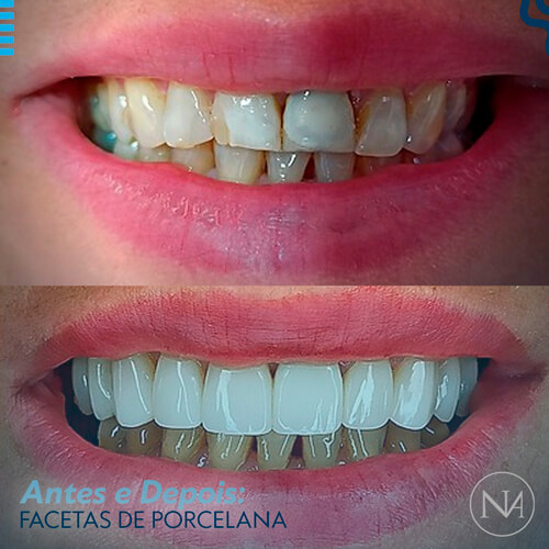 FACETAS-PORCELANA--NASSER-11