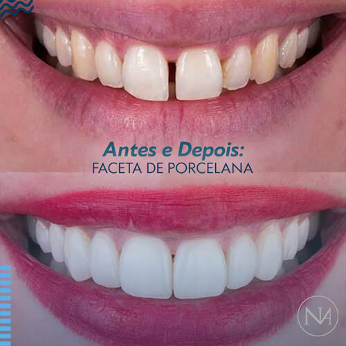 FACETAS-PORCELANA--NASSER-12