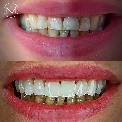FACETAS-PORCELANA--NASSER-13