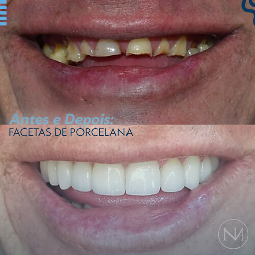FACETAS-PORCELANA--NASSER-14
