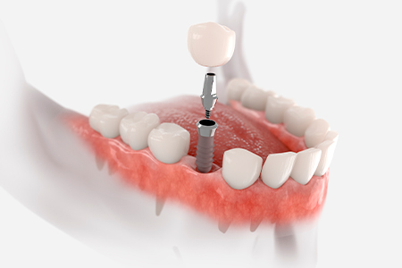 IMPLANTE-DENTARIO-CLINICA-NASSER