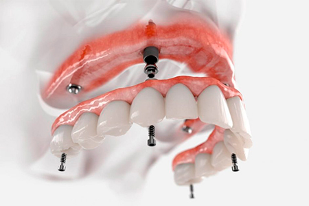 PROTESE-DENTARIA-CLINICA-NASSER