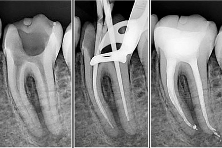ENDODONTIA-002
