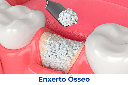 ENXERTO-ÓSSEO-001