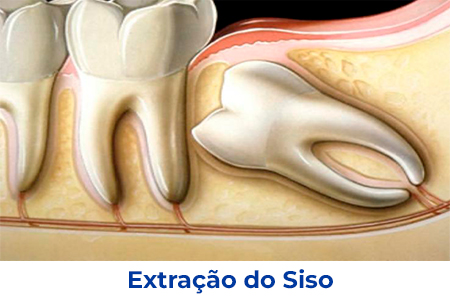 EXTRAÇÃO-DE-SISO-001